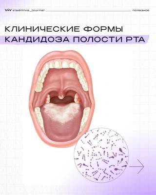 Кандидоз полости рта: от налёта до эрозий.
